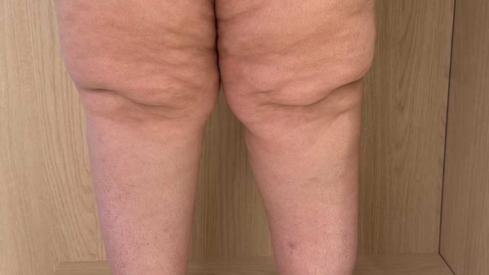 Artigo sobre lipedema